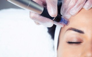 Microneedling